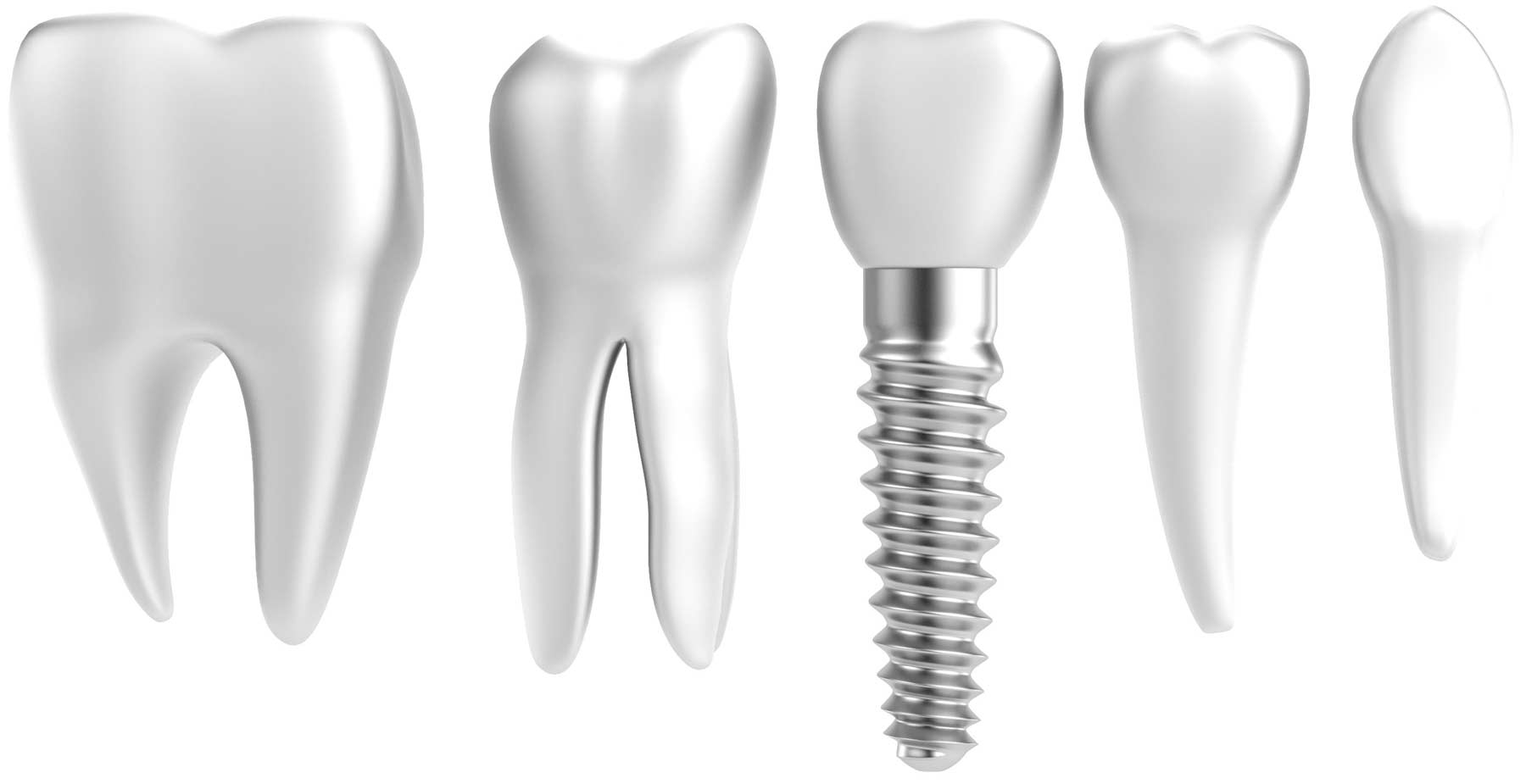 Zähne und Implantate von Zahnarzt Lindenberger